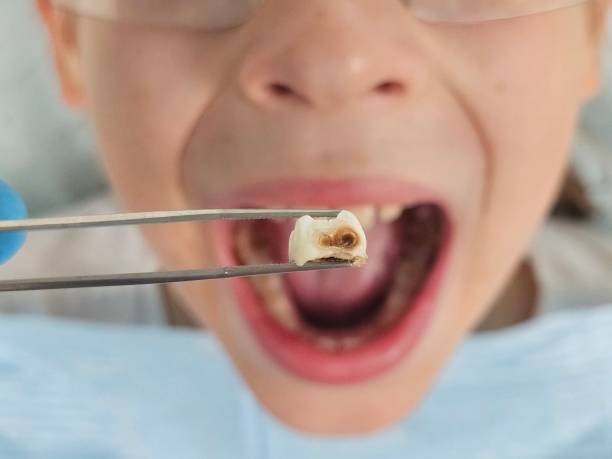 Best Emergency Dental Care for Broken or Chipped Teeth in Ackley, IA